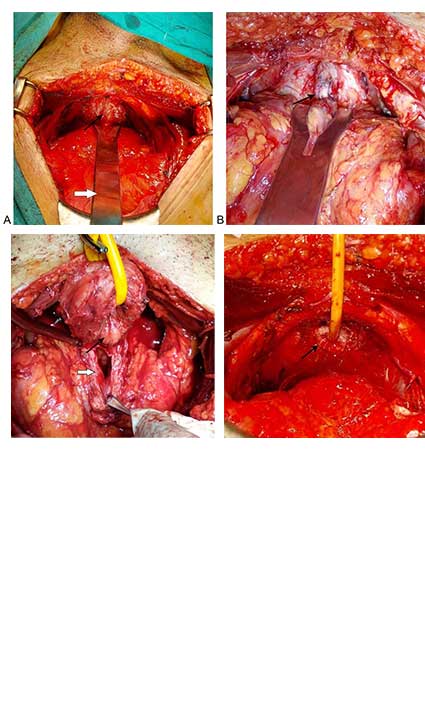 Open radical retropubic prostatectomy as a saviour in the era of robotics- a single surgeon experience