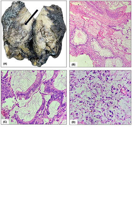 The Urological Subtleties of an Uncommon Encounter with Primary Mucinous Adenocarcinoma of the Urinary Bladder with Review of Literature